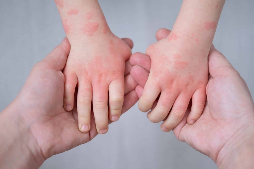 Java Kombëtare e Ekzemës (National Eczema Week): Si ta njohim dhe menaxhojmë ekzemën te fëmijët